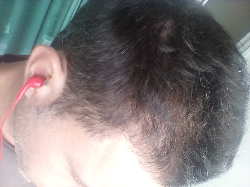 Comment lutter efficacement contre les chutes de cheveux ?