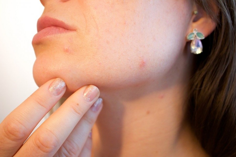 Venir à bout d'un bouton sous la peau